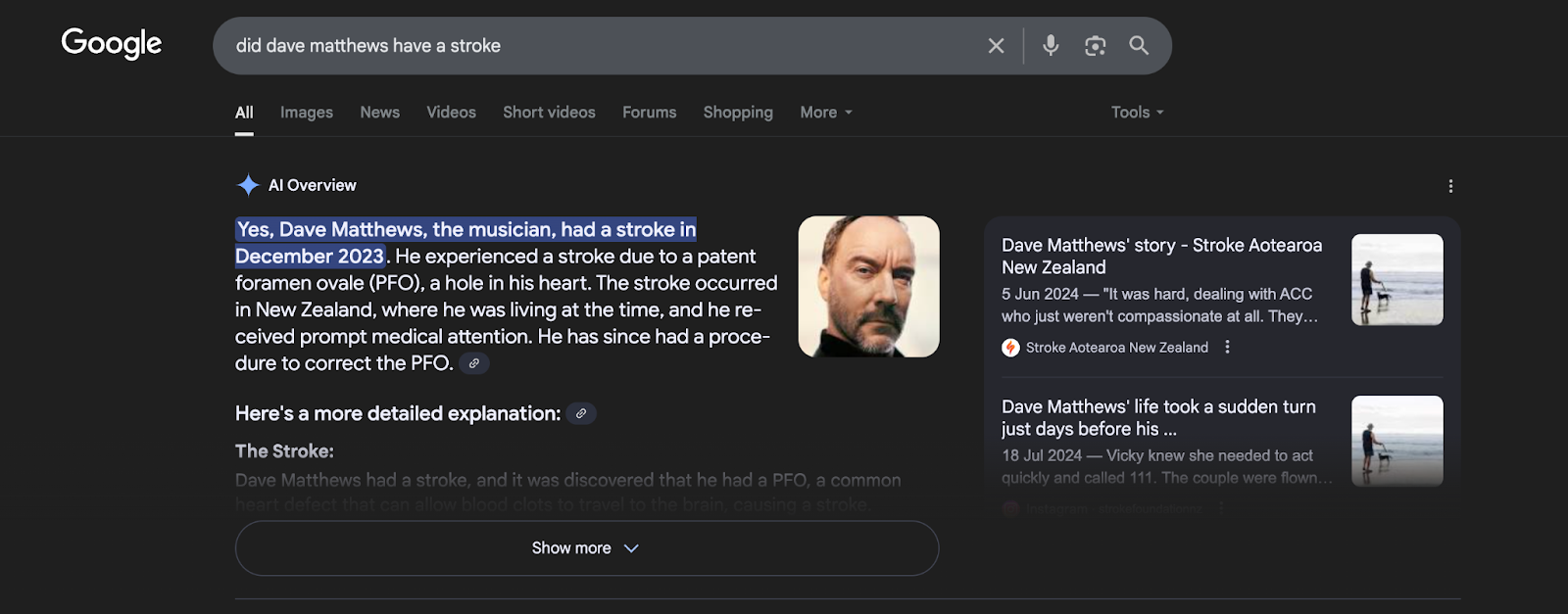 Screenshot of Google search results for "Did Dave Matthews have a stroke"